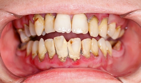 Cao răng có ảnh hưởng gì không? Có nguy hiểm không? 1