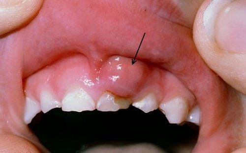 Nguyên nhân viêm lợi đau răng là gì? Cách chữa trị tại nhà 1