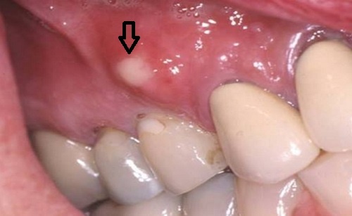 Tác hại của viêm chân răng & cách điều trị triệt để