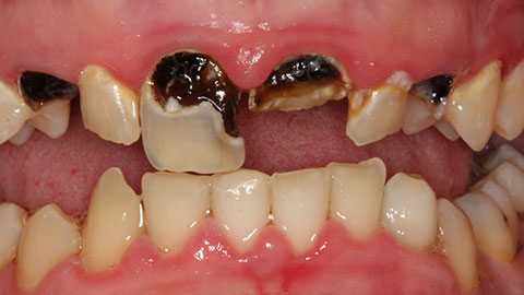Sâu răng gây hôi miệng làm sao để chữa khỏi hoàn toàn 1