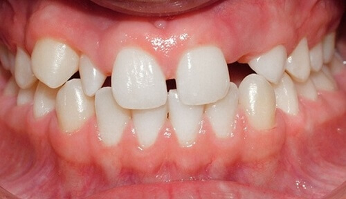 Điều trị răng thưa hiệu quả bằng kỹ thuật trám răng thưa 1