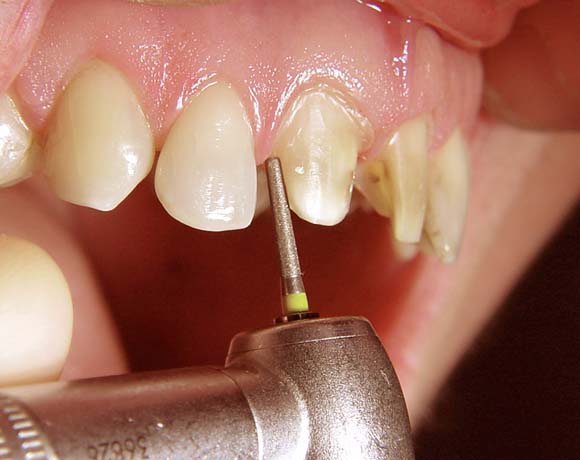 Răng cửa bị hô vẩu có nên mài răng không? Có ảnh hưởng không? 2