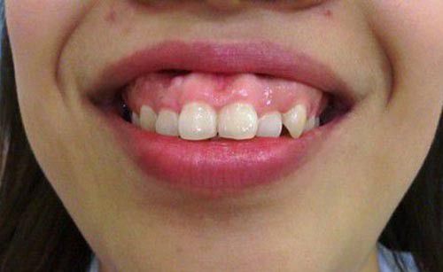 Răng cửa bị hô vẩu có nên mài răng không? Có ảnh hưởng không? 1