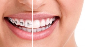 Răng xấu phải làm sao khắc phục hiệu quả nhất 1