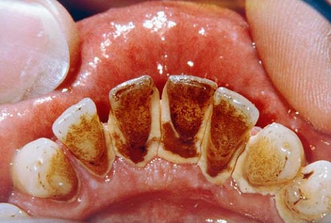 5 cách giải quyết triệt để mảng bám đen chân răng 1