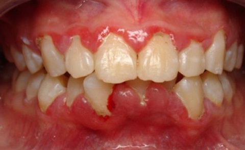 Viêm chân răng hàm: Nguyên nhân và cách điều trị an toàn 1