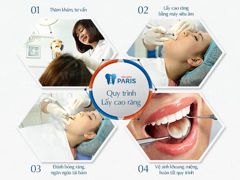 Cách lấy cao răng siêu âm tại nha khoa Paris
