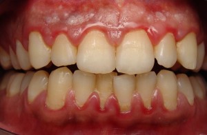 Cách điều trị viêm chân răng có mủ HIỆU QUẢ ngay tại nhà 3
