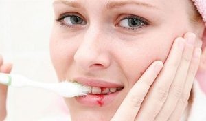 Phương pháp ngăn chặn chảy máu chân răng HIỆU QUẢ TUYỆT ĐỐI 1
