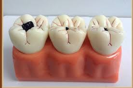 Mách bạn cách chữa sâu răng hàm TRIỆT ĐỂ tận gốc 100% 1