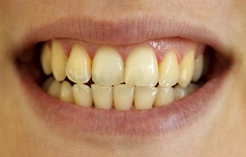 Răng ố vàng có nên tẩy trắng răng không