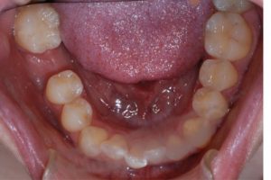 Sự thật mất răng lâu năm có làm sao không, có hại không? 1