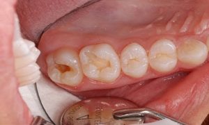 Đi tìm câu trả lời chính xác nhất: Chữa sâu răng có đau không? 1