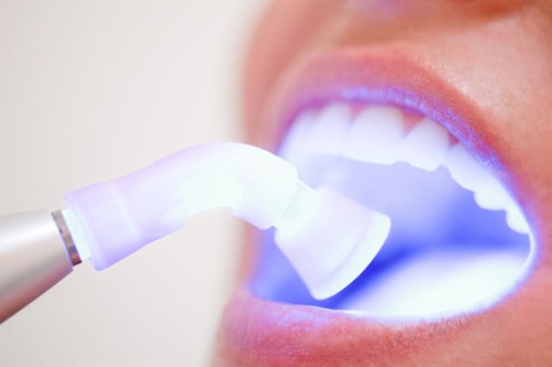 Tẩy trắng răng bằng đèn plasma hiện đại Tẩy trắng răng bằng đèn plasma hiện đại 1