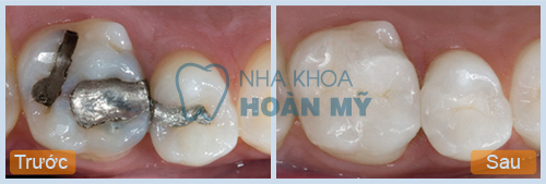 Bé 3 tuổi bị sâu răng phải làm sao cho hết?