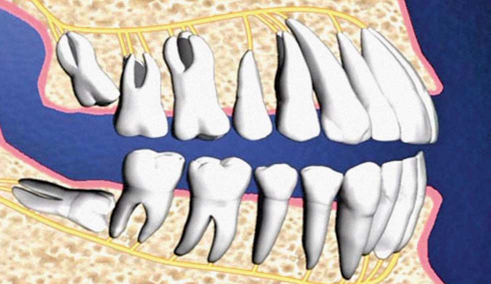 Có nên nhổ răng số 8 bị mọc lệch không?