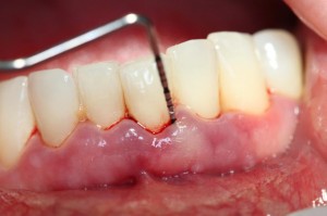 Đánh răng bị chảy máu chân răng có nguy hiểm không?