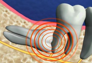 Nhổ răng hàm số 8 hết bao nhiêu tiền?