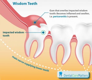 Nhổ răng số 8 hàm dưới có đau không?