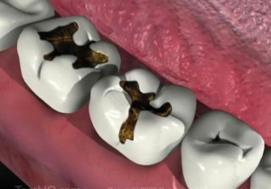 Có cách nào tự chữa trị răng sâu được không?