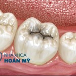 Xử lý như thế nào khi bị sâu răng hàm?