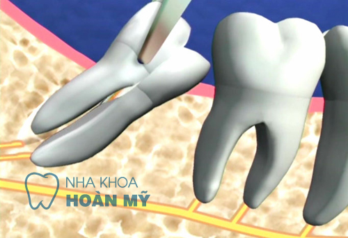 Khi nào nên nhổ răng số 8?