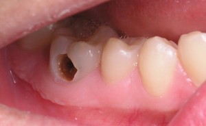 Răng sâu đau nhức – phương pháp điều trị nào tối ưu?