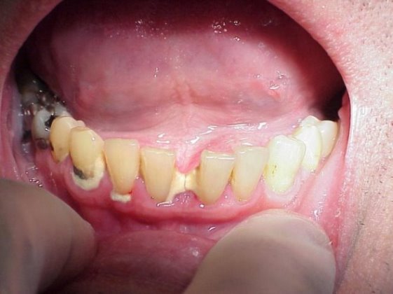 Sâu răng khi đang mang thai có nên nhổ hay không?