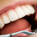 Cạo vôi răng thường xuyên quá có tốt hay không?