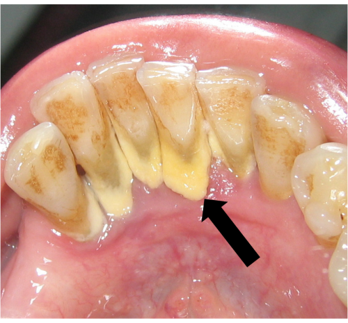Lấy cao răng có hại gì đến răng hay không?