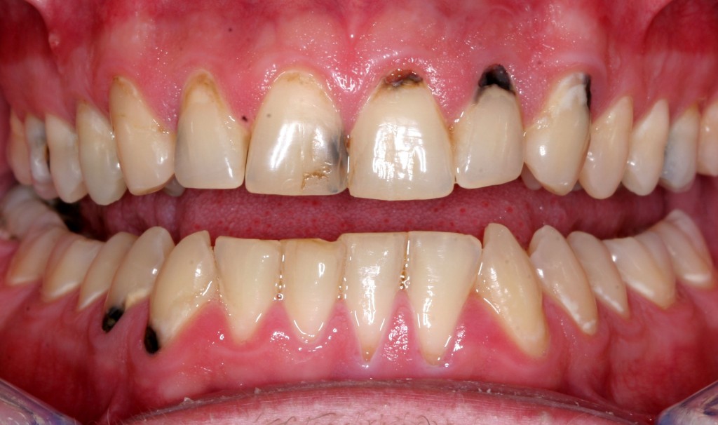 Răng dễ bị sâu do những nguyên nhân gì? 2