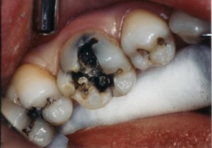 Răng sâu nặng có cần thiết phải nhổ hay không?
