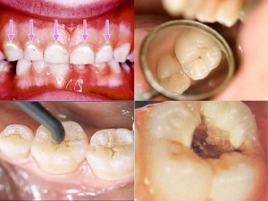 Răng sâu nặng liệu có hàn trám được không?