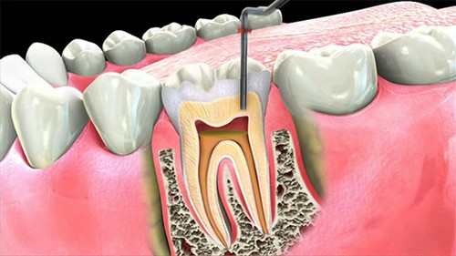 Các bước lấy tủy răng an toàn diễn ra như thế nào?