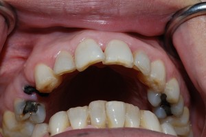 Cách nào khắc phục răng sâu bị mẻ tốt nhất?