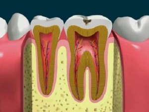 Hàn trám răng lấy tủy có đau không?