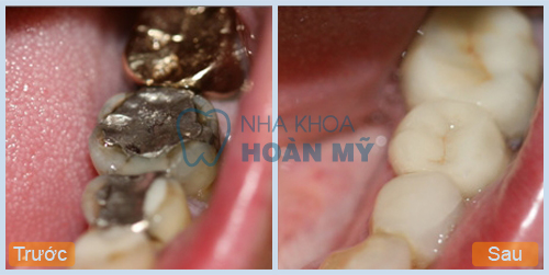 Răng bị sâu vào tủy có trám được không?