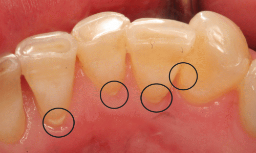 Lấy cao răng có ảnh hưởng gì tới răng miệng không?