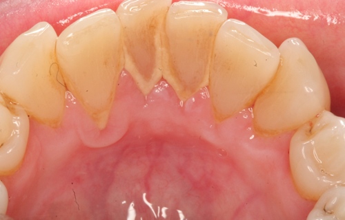 Tác dụng của lấy cao răng đối với sức khỏe răng miệng
