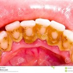 Các phương pháp lấy cao răng phổ biến hiện nay