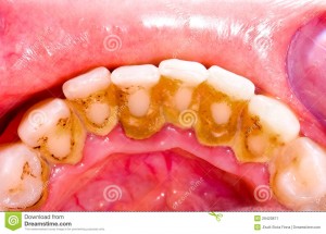 Các phương pháp lấy cao răng phổ biến hiện nay