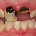 Giá chữa răng sâu tại Nha khoa Hoàn Mỹ là bao nhiêu?