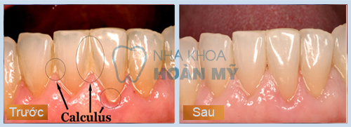 Lấy cao răng có làm trắng răng hay không?