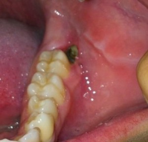 Nhổ răng khôn có thực sự không đau?