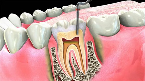 Rút tủy răng hàm có đau nhiều không?