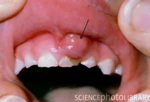Viêm lợi và chảy máu chân răng có nguy hiểm không?