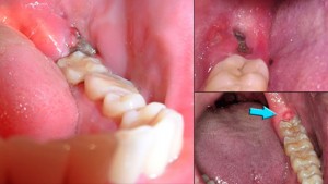 Có nên hàn răng số 8 bị mẻ và chớm sâu?