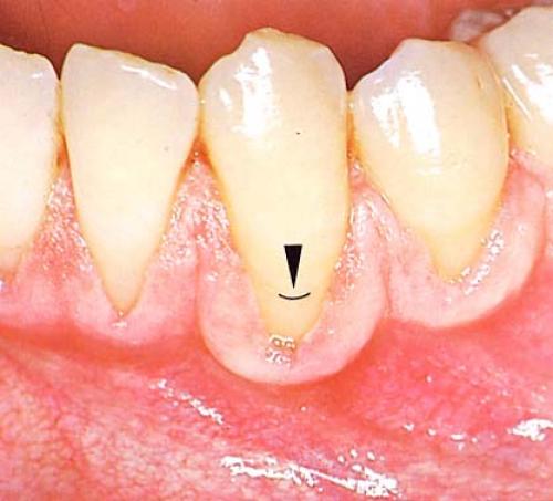 Giải pháp nào khắc phục bệnh tụt nướu hiệu quả?