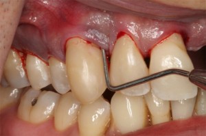 Răng bị áp xe cần được điều trị như thế nào?
