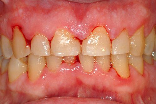 Viêm nướu ở phụ nữ mang thai có nguy hiểm không?